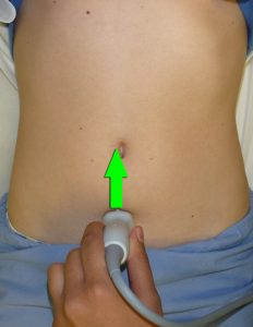 saggital probe position- pelvis