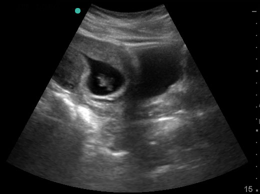 Transabdominal uterus, longitudinal, IUP