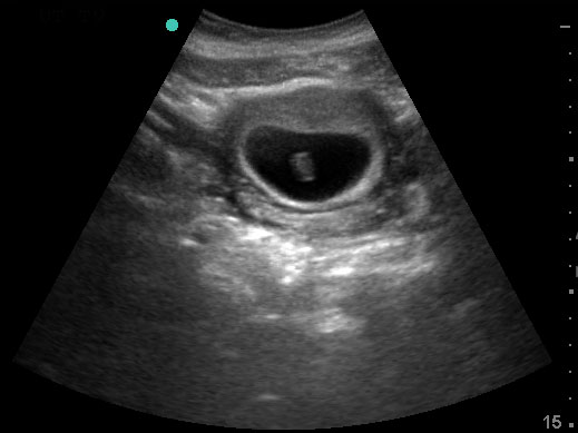 Transabdominal uterus, transverse with IUP