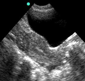 Transabdominal Uterus, Sagittal