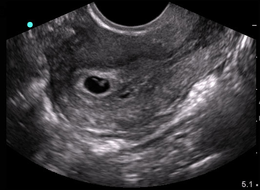 Transvaginal uterus, longitudinal, IUP