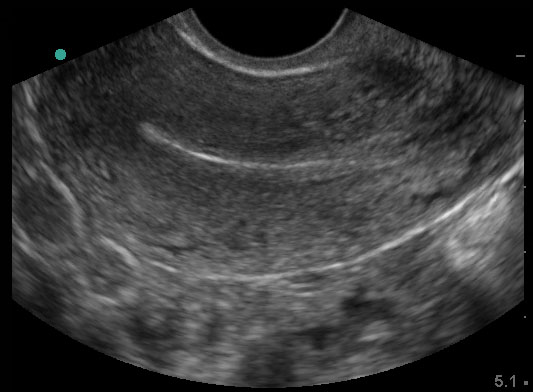 Transvaginal uterus, longitudinal