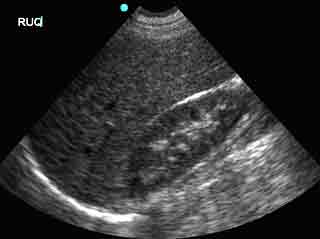 Right Upper Quadrant- normal ultrasound