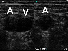 Compression of femoral vein