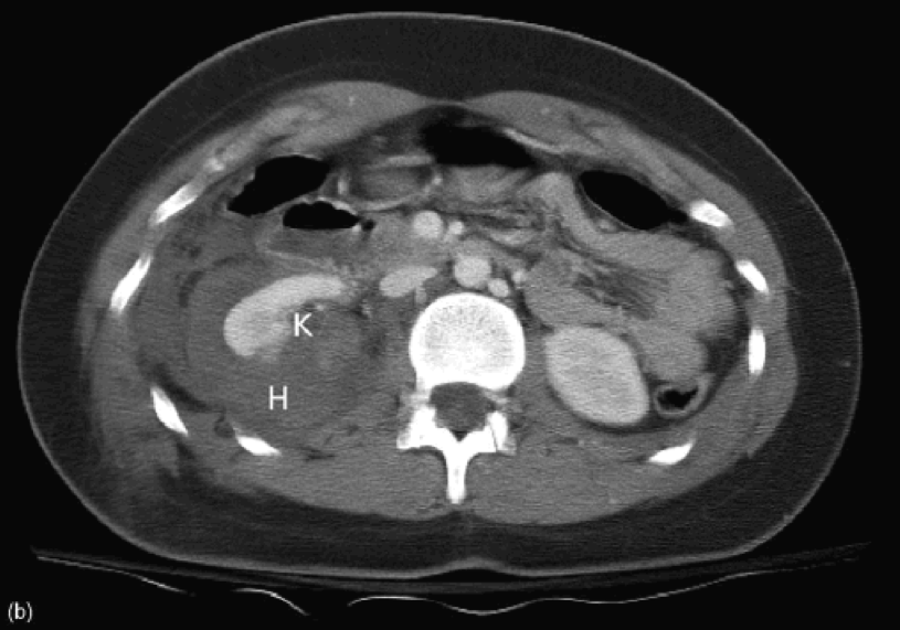 CT Abdomen with Renal Injury
