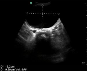 Bladder volume assessment with ultrasound- transverse