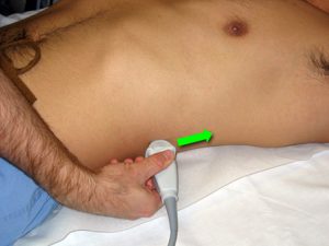 Left renal ultrasound probe position