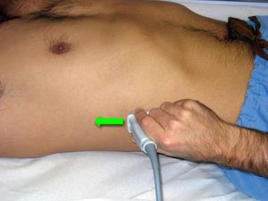 Right renal ultrasound probe position