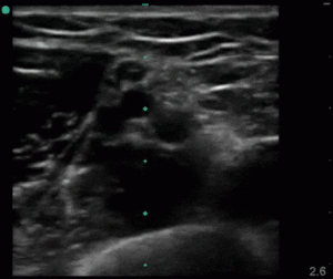 Brachial vv art median nerve