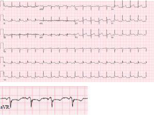 Pericarditis