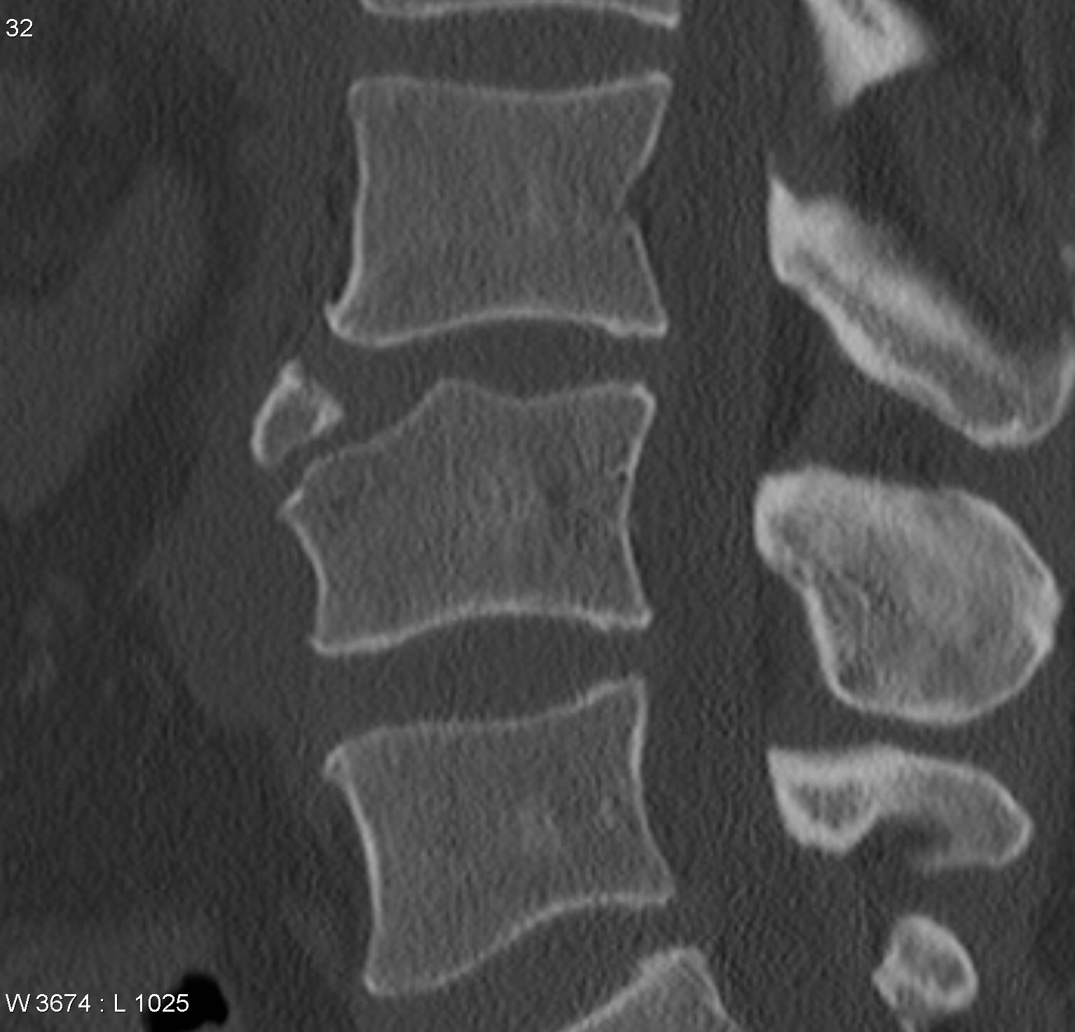 cervical spine fracture x ray