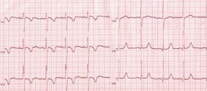 Juvenile-T-wave-inversion