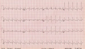Normal-paeds-ECG-2-year-old-boy