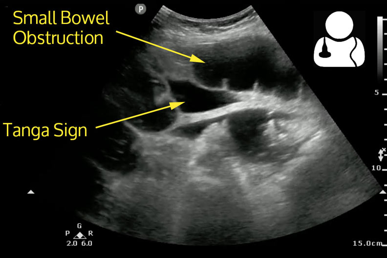 SBO And Ultrasound Genie In A Bottle SinaiEM