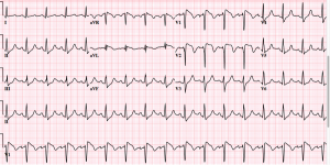 brooks-ecg-1