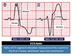 modified-sgarbossa-criteria