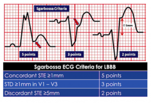 original-sgarbossa-criteria