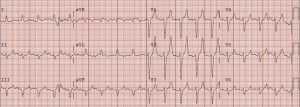 hyperkalemia-8-5-very-tented