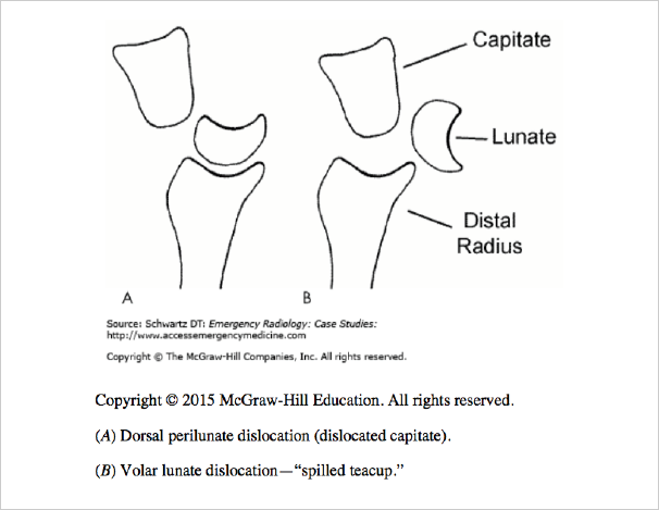 lunate dislocation spilled teacup