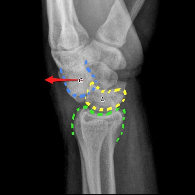 lunate dislocation spilled teacup