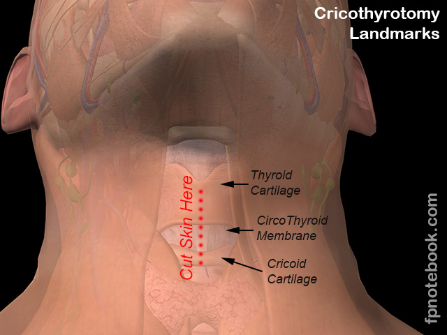 Control-Cric Emergency Cricothyrotomy