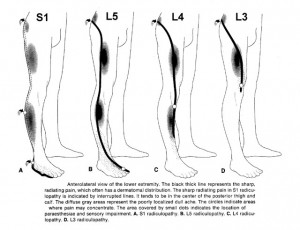 http://www.neuroanatomy.wisc.edu/SClinic/Radiculo/Radiculopathy.htm