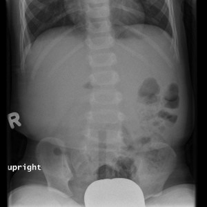 Gas-less right side of abdomen Case courtesy of Dr Angela Byrne, Radiopaedia.org, rID: 8113