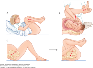 Source: Chapter 133. Shoulder Dystocia Management, Emergency Medicine Procedures, 2e Citation: Reichman EF. Emergency Medicine Procedures, 2e; 2013 Available at: http://accessemergencymedicine.mhmedical.com/content.aspx?sectionid=45343778&bookid=683&jumpsectionID=45354637&Resultclick=2 Accessed: January 13, 2017