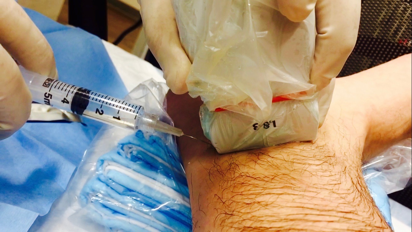 Lower Extremity Nerve Block: The Sural Nerve | SinaiEM