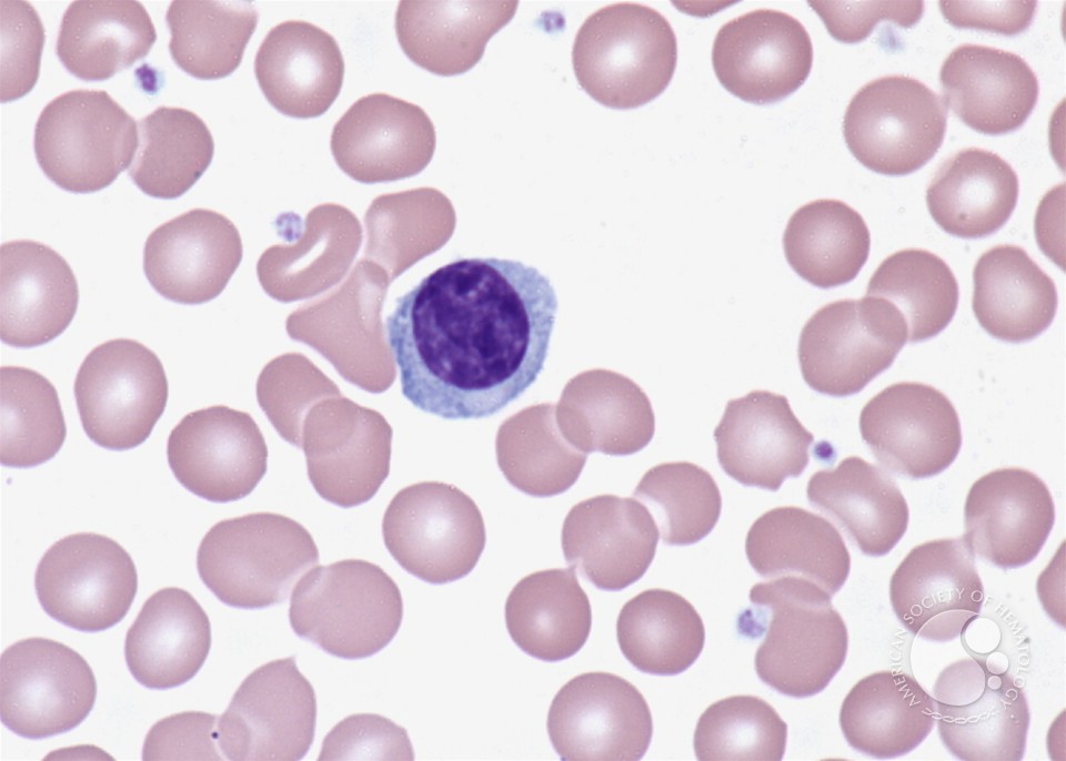 What Is A Lymphocyte Count Uk