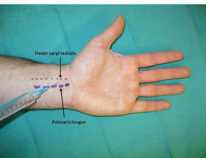 Median Nerve Block