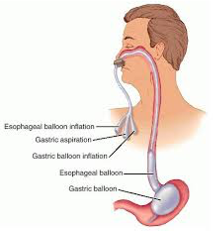 sengstaken blakemore tube inflation