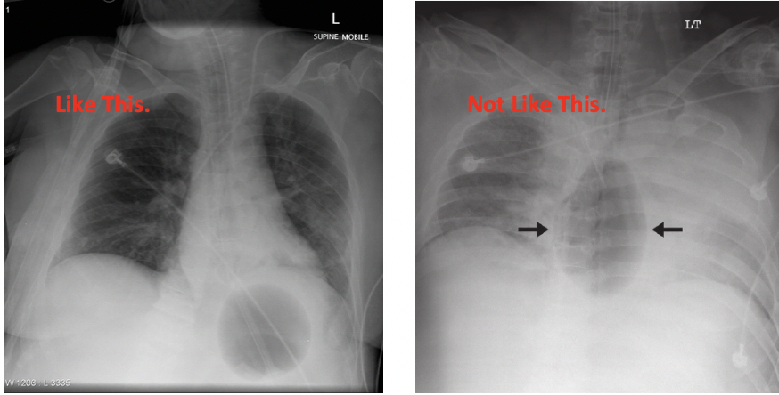 esophageal varices x ray