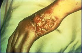 Drug Rashes - Skin Disorders - MSD Manual Consumer Version