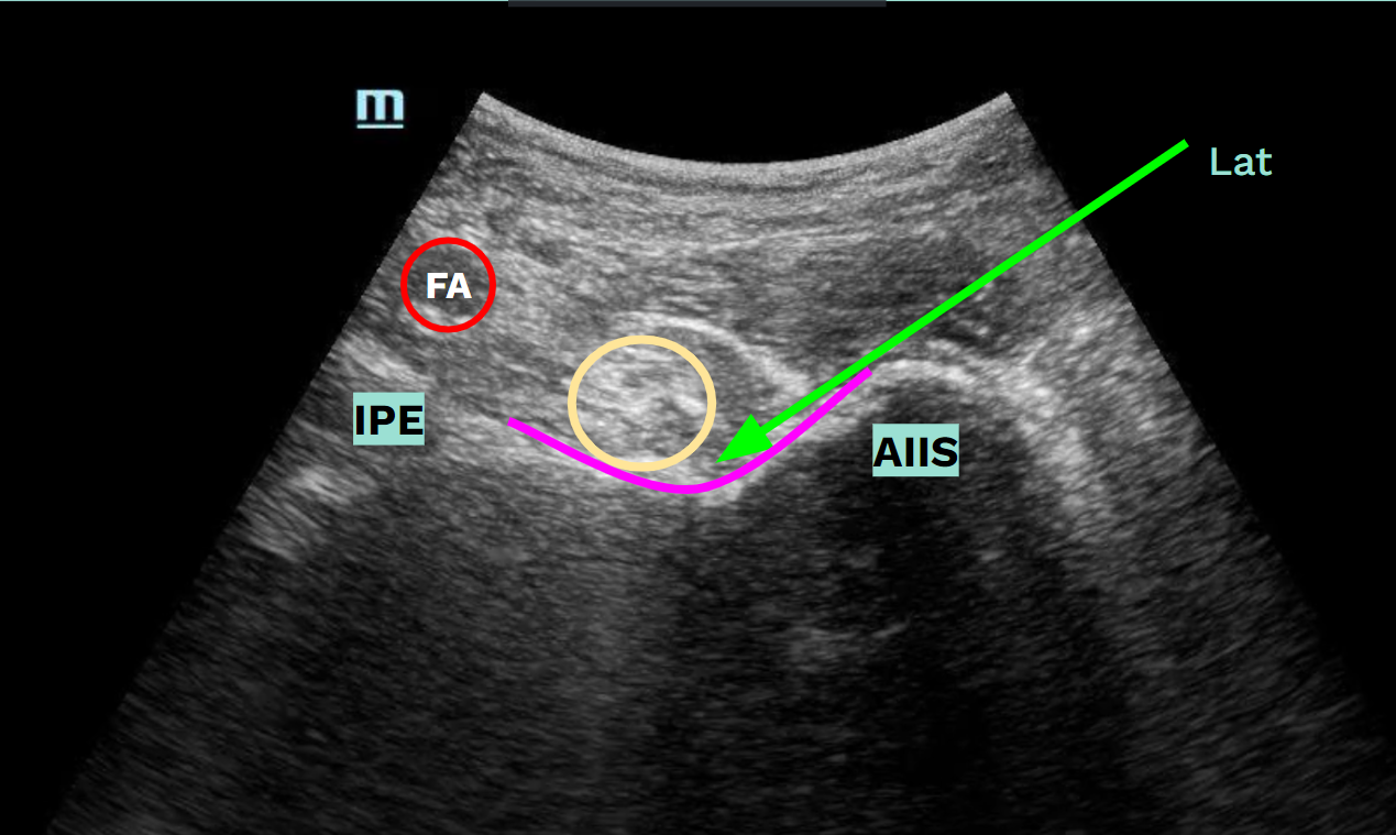 Pericapsular Nerve Group Block (PENG block)