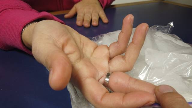 Arlington Co. Fire helps woman remove ring from swollen finger - WTOP News