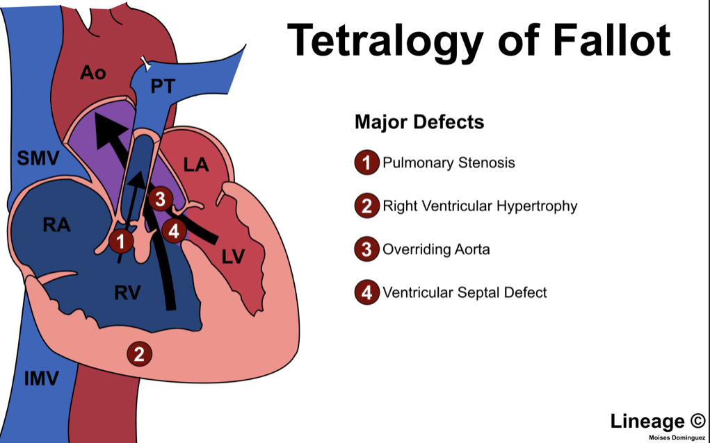 Tetralogy of Fallot – Hypercyanotic Spell