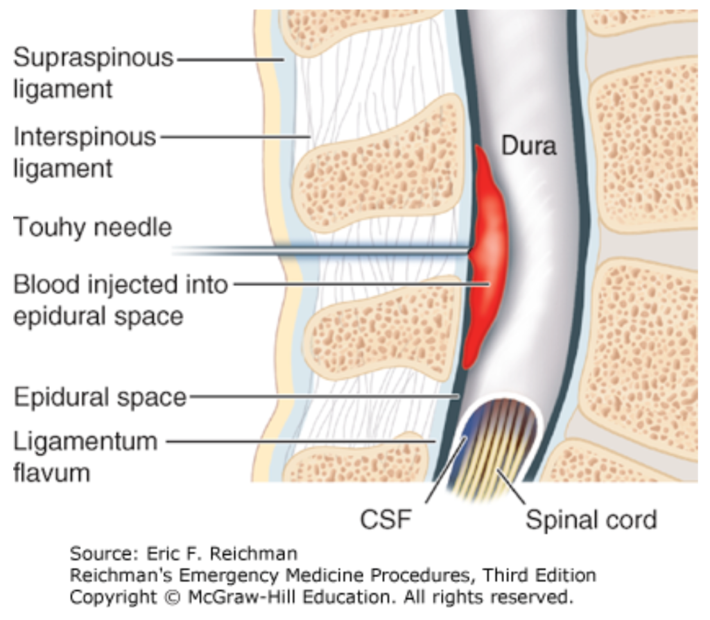 The perils of puncture: post lumbar puncture headaches & what to do ...